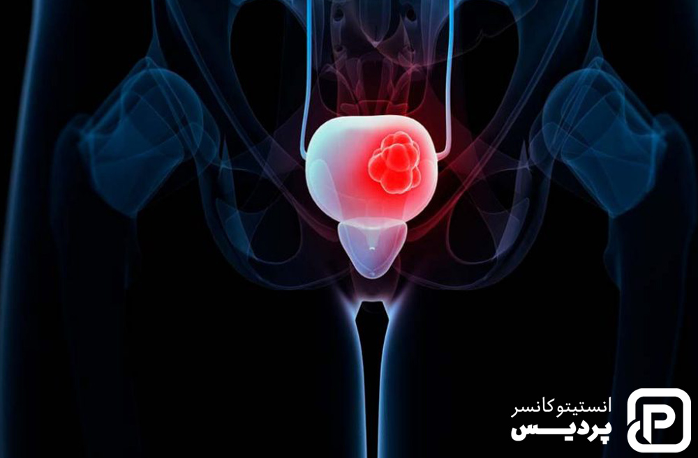 همه چیز در مورد سرطان مثانه 7 پیشگیری از سرطان مثانه