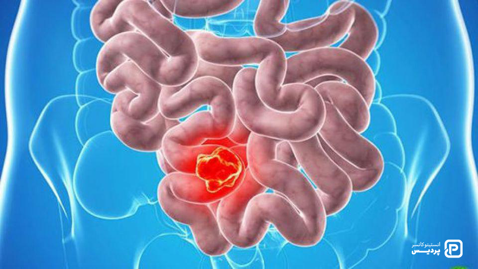راه های تشخیص سرطان روده باریک