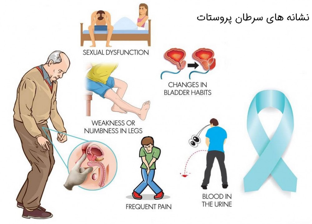 سرطان پروستات