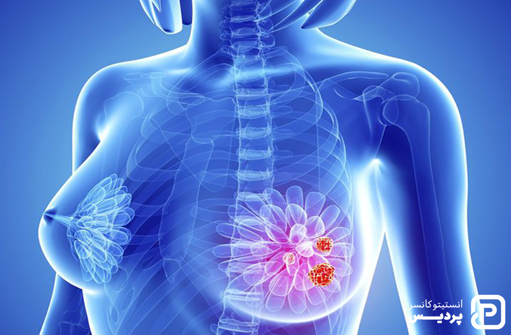 مرحله بندی سرطان سینه