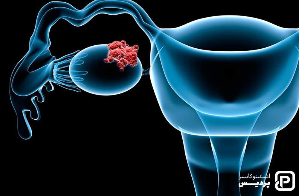 سرطان تخمدان را بیشتر بشناسید 9 زندگی پس از درمان سرطان تخمدان