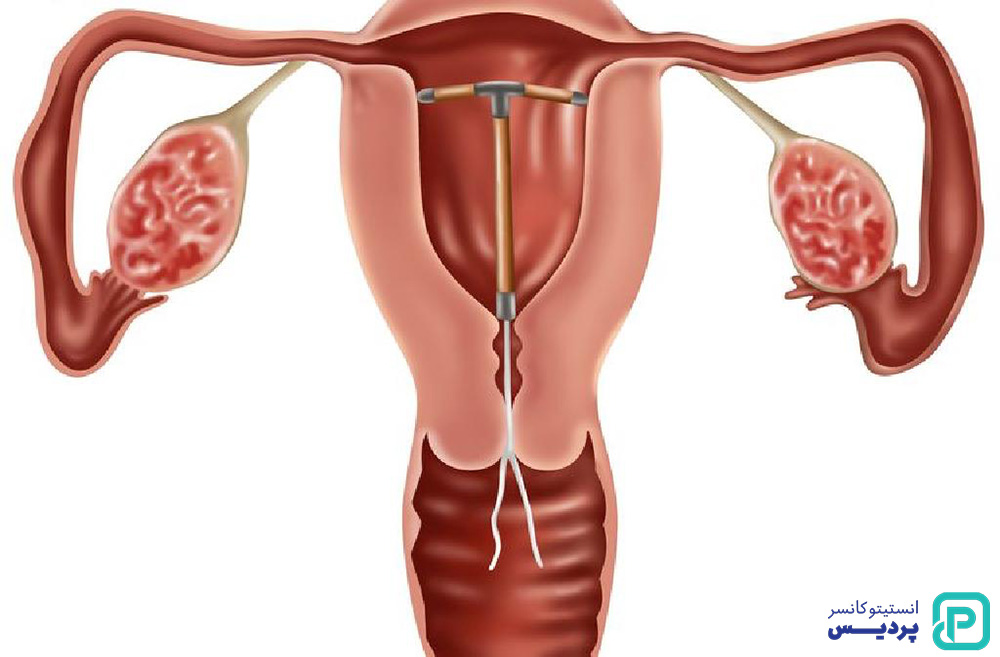 عوامل خطر سرطان دهانه رحم را بیشتر بشناسید