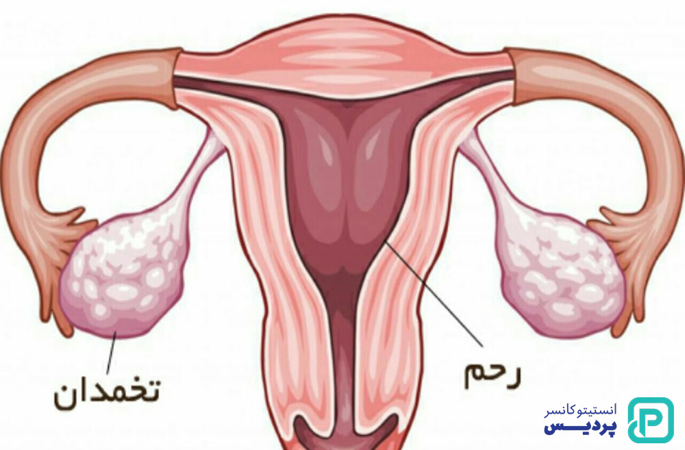 سرطان تخمدان را بیشتر بشناسید 2 شناخت سرطان تخمدان