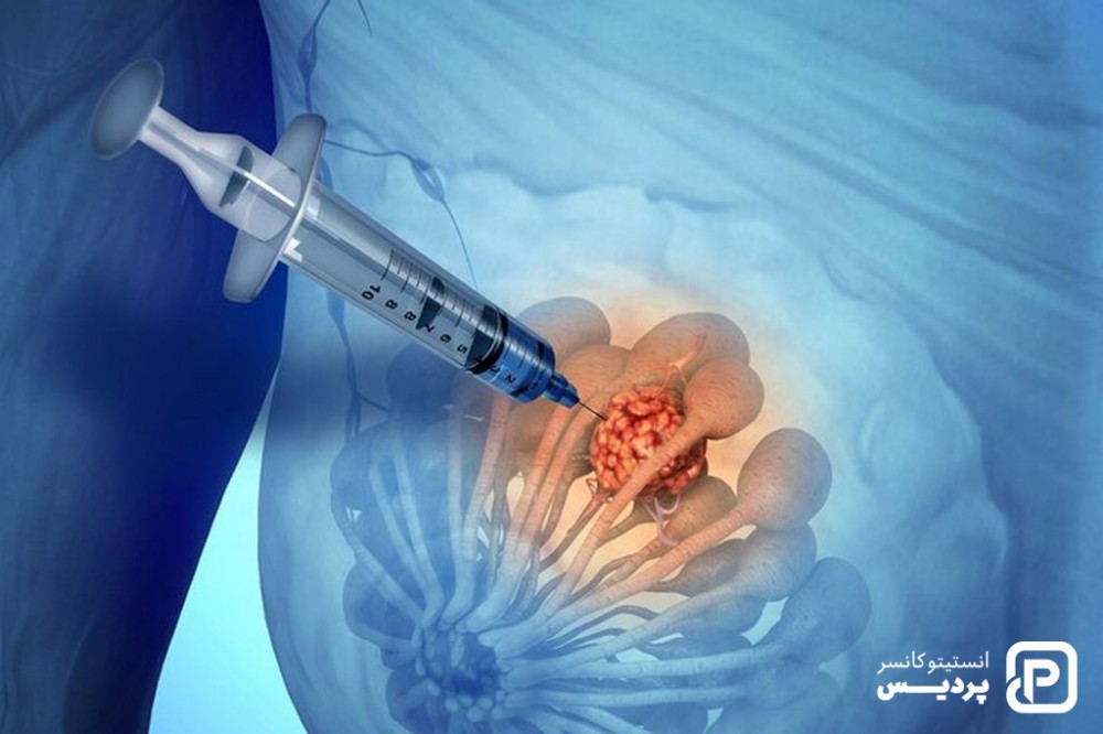 تشخیص سرطان پستان