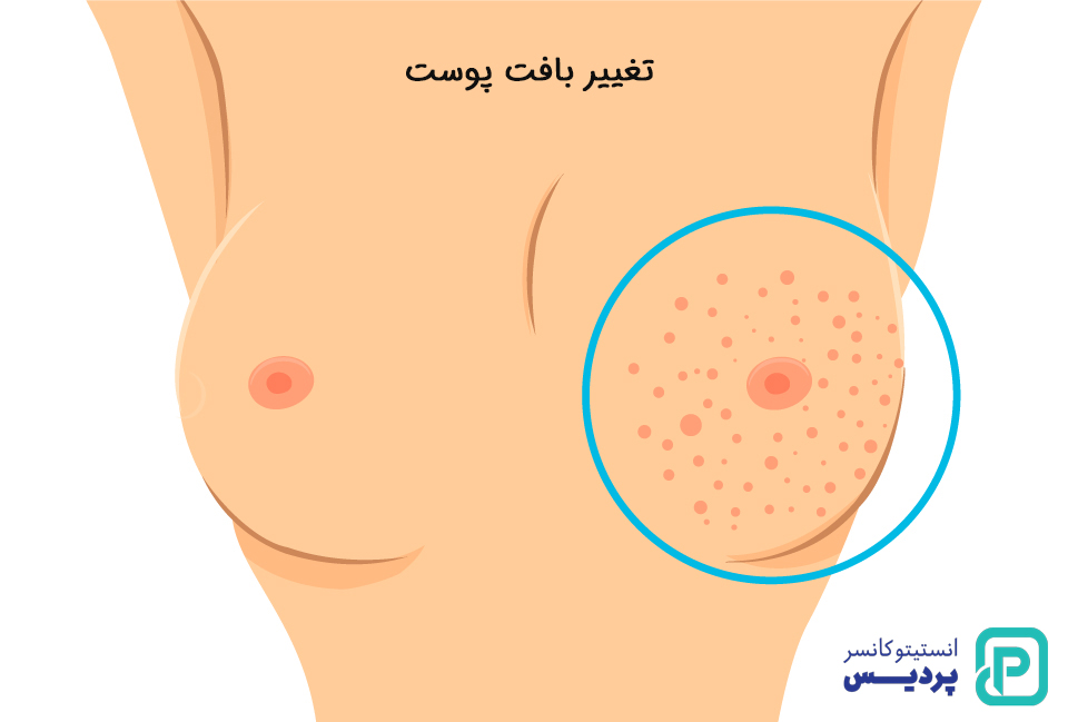 علائم هشدار دهنده اولیه سرطان پستان