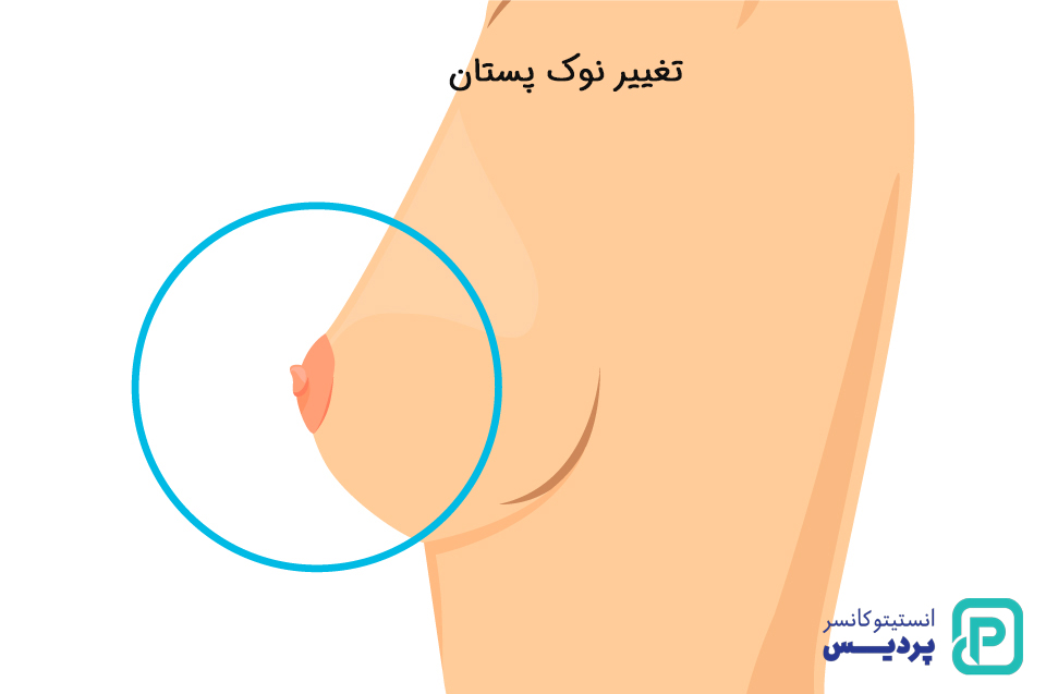 علائم کارسینوم داکتال
