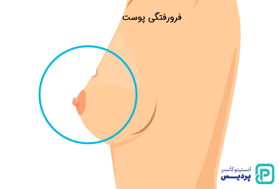 علائم کارسینوم پاپیلاری پستان