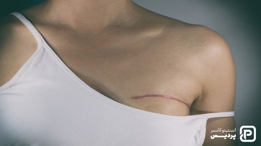 جراحی برای درمان سرطان سینه