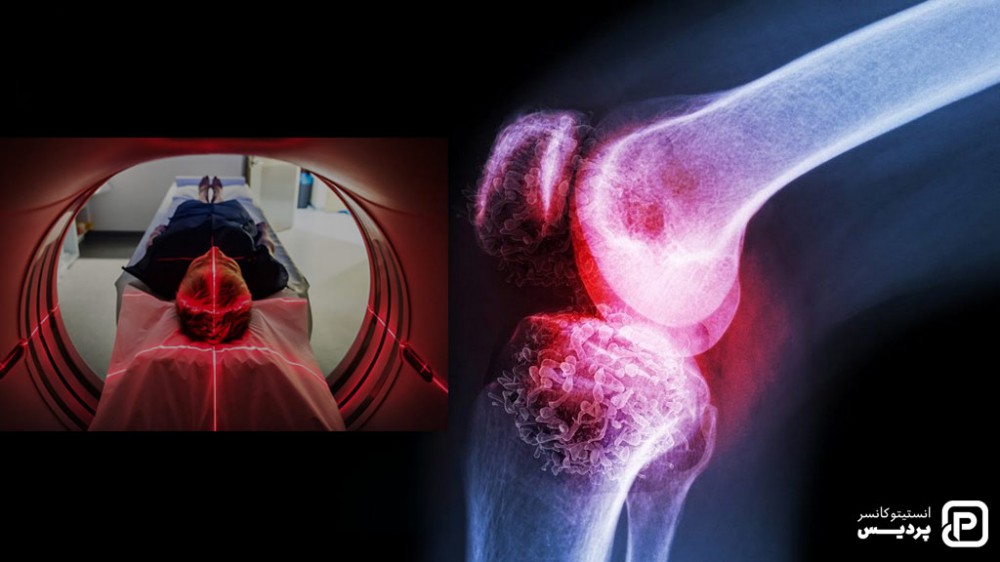 با روش های تشخیص سرطان استخوان و چگونگی انجام آنها آشنا شوید 3 اسکن استخوان برای تشخیص سرطان استخوان