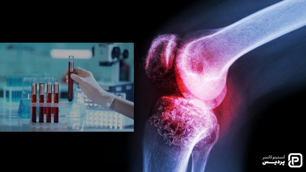 با روش های تشخیص سرطان استخوان و چگونگی انجام آنها آشنا شوید 2 آزمایش خون برای تشخیص سرطان استخوان