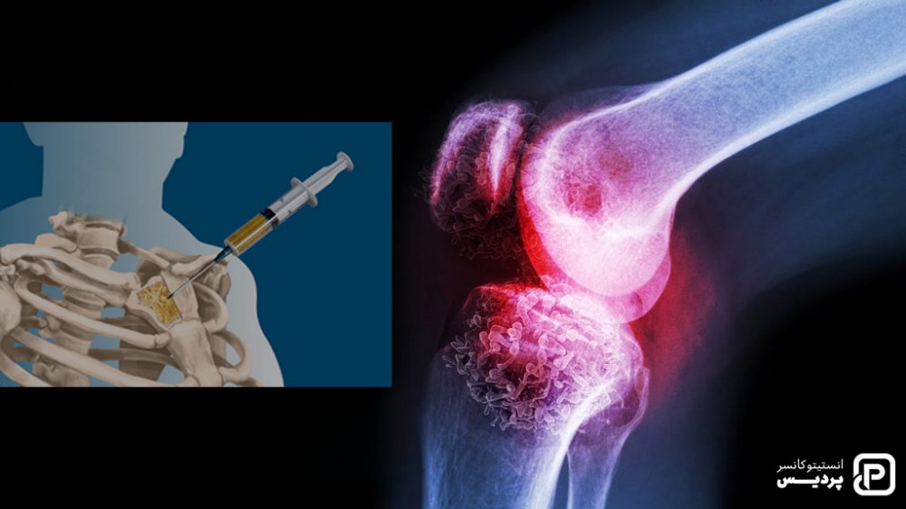 با روش های تشخیص سرطان استخوان و چگونگی انجام آنها آشنا شوید 4 نمونه برداری برای تشخیص سرطان استخوان