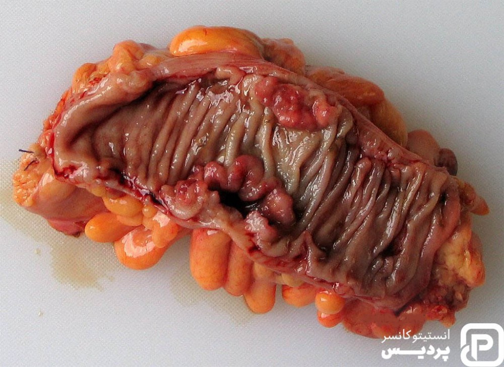 سرطان روده بزرگ