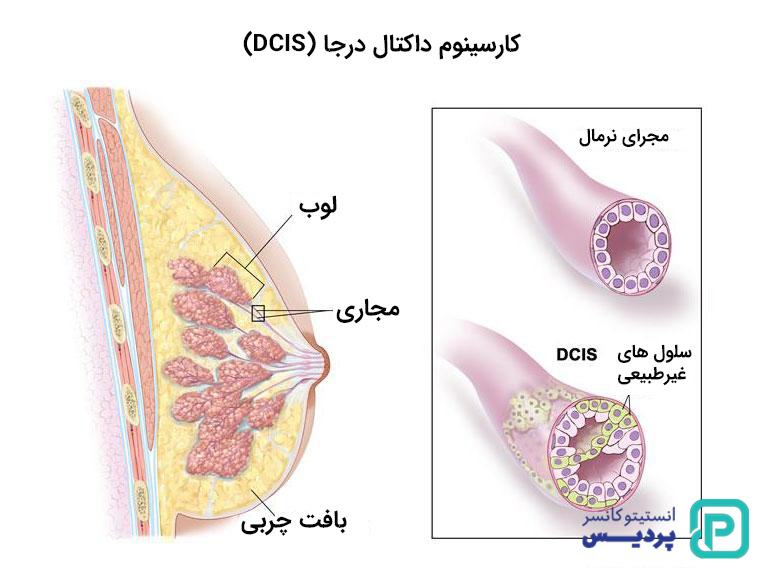 انواع سرطان پستان