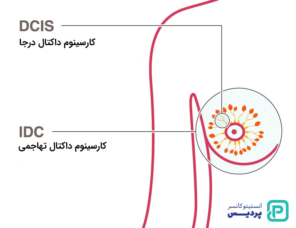 انواع سرطان سینه