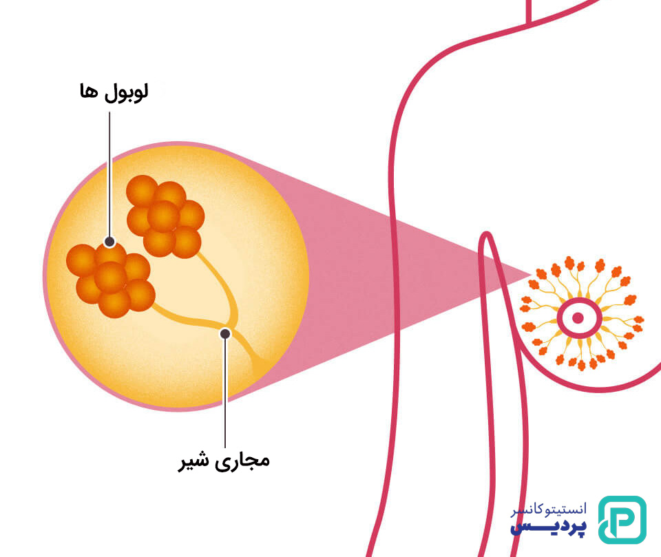 انواع سرطان پستان