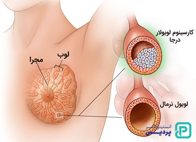 انواع سرطان پستان
