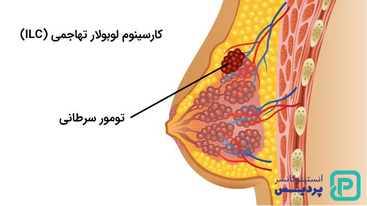 انواع سرطان پستان