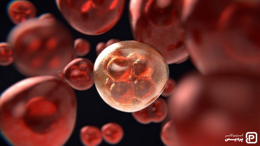 مراحل سرطان خون حاد میلوژن