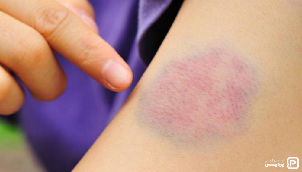 علائم و نشانه های سرطان خون