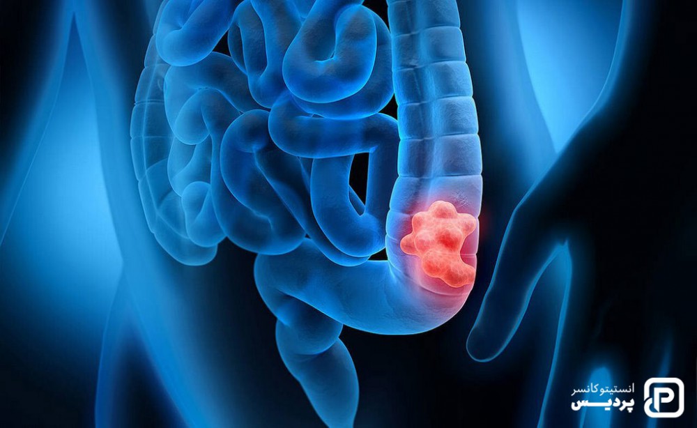 سرطان متاستاتیک روده چه علائمی دارد