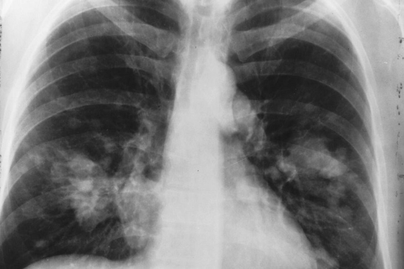 مواجه با سرطان ریه