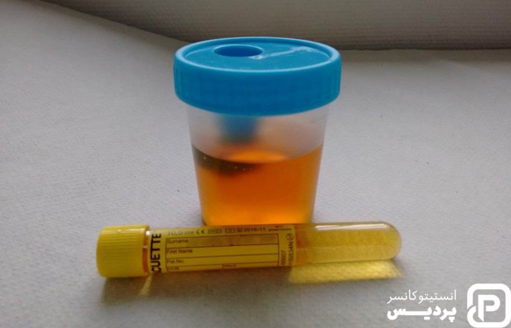 سرطان پروستات 