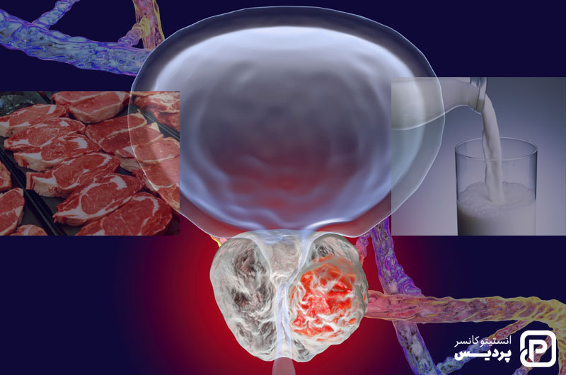 تأثیر رژیم غذایی بر ابتلا به سرطان پروستات