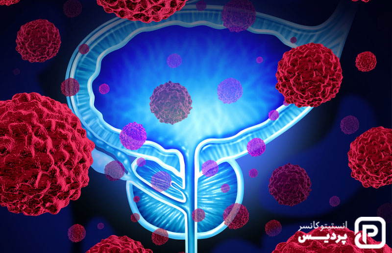 تغییرات ارثی ژن ها می تواند خطر ابتلا به سرطان پروستات را افزایش دهد