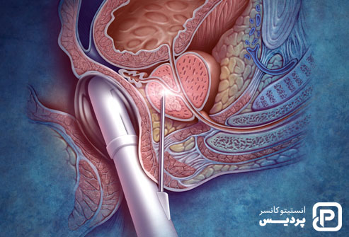 سرطان پروستات پیشرفته، علائم و نشانه ها و راههای تشخیص و درمان آن 3 بیوپسی پروستات یکی از راههای تشخیص سرطان پروستات پیشرفته می باشد