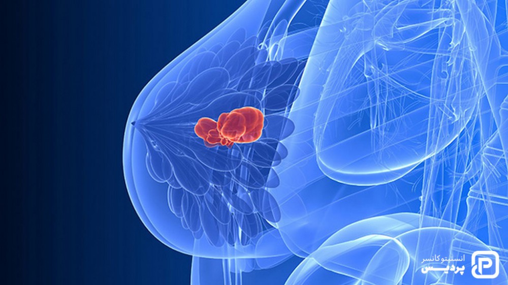 سرطان سینه عود کننده چیست و چه علائمی دارد 3 عود سرطان سینه در همان نقطه ای که سرطان اولیه رخ داده بود