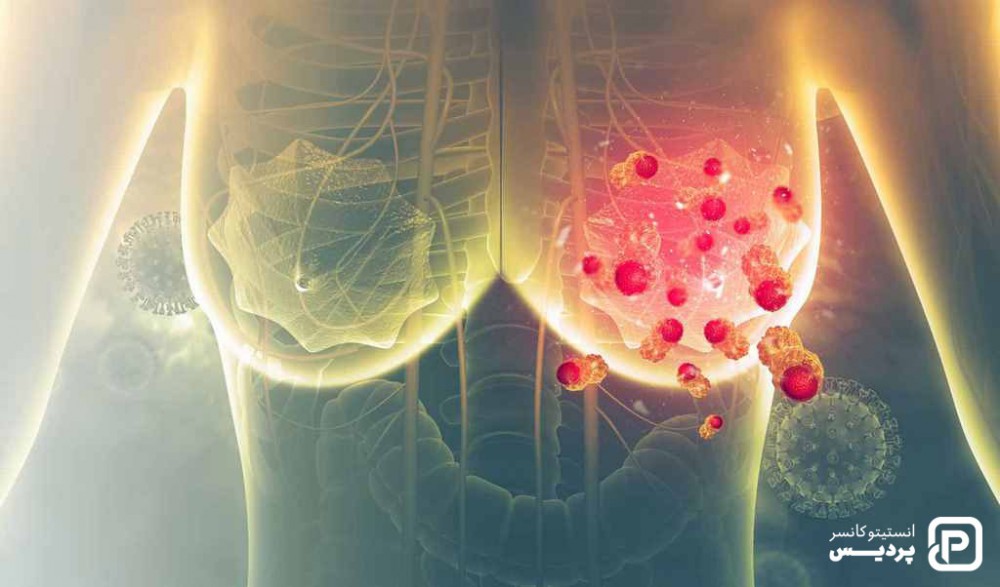 سرطان سینه عود کننده چیست و چه علائمی دارد 4 عود موضعی سرطان سینه