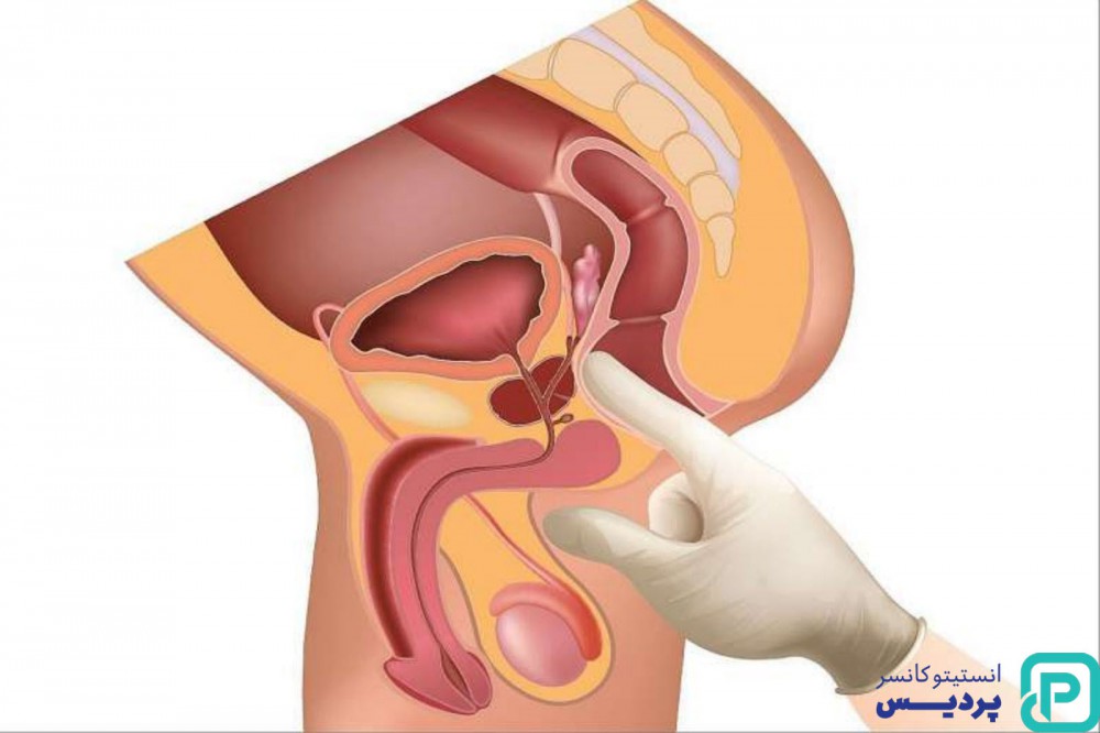 تشخیص به موقع سرطان پروستات 