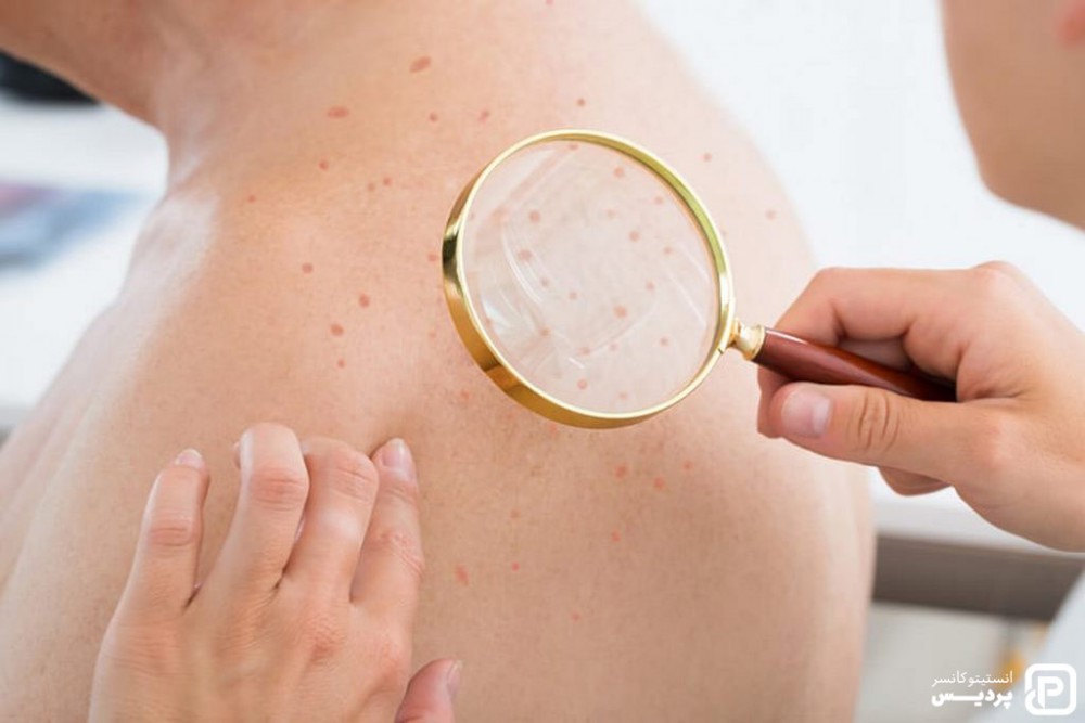 انواع سرطان پوست را بشناسید 6 کراتوزاکتینیک