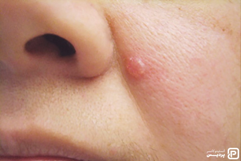 انواع سرطان پوست را بشناسید 2 کارسینوم سلول بازال