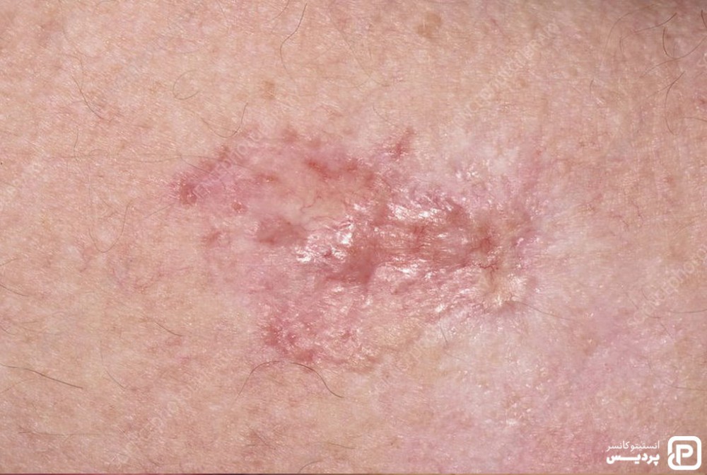 انواع سرطان پوست را بشناسید 3 عود کردن کارسینوم سلول بازال