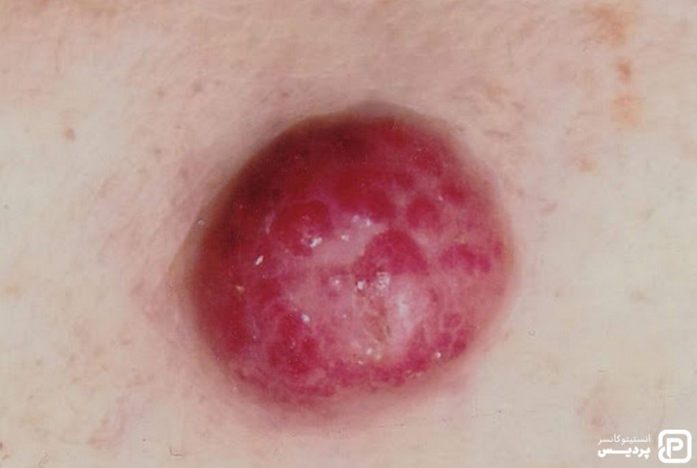 انواع سرطان پوست را بشناسید 5 سرطان پوستی ملانوما