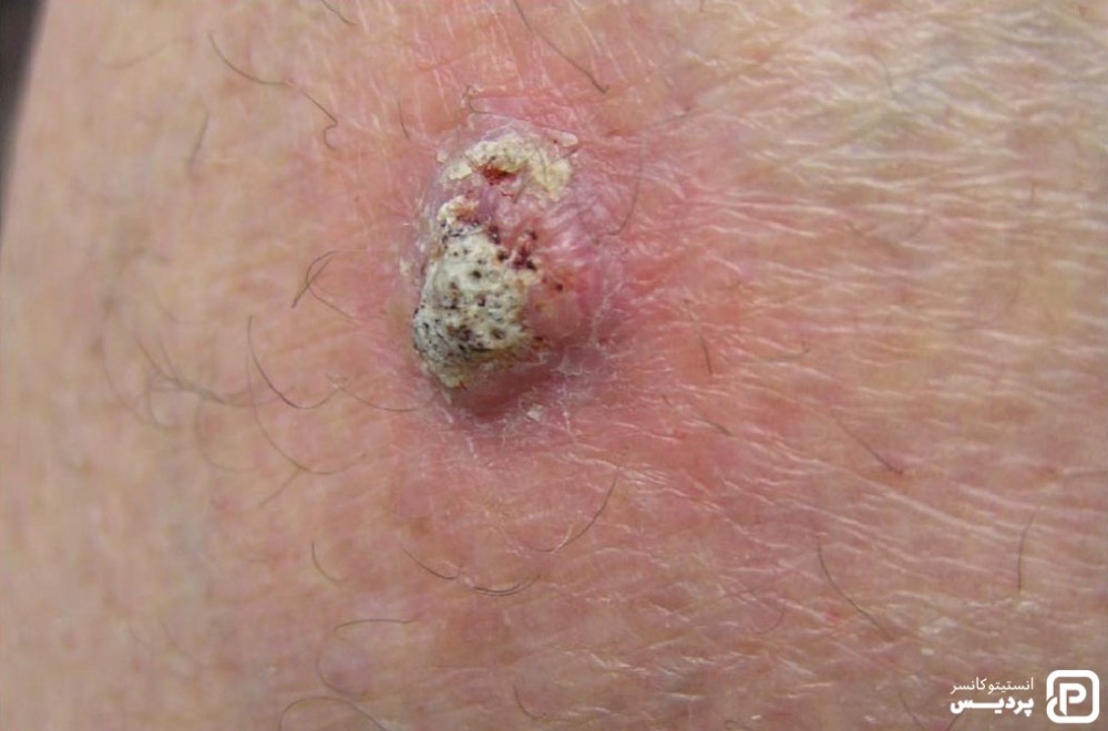انواع سرطان پوست را بشناسید 4 سرطان سلول سنگفرشی