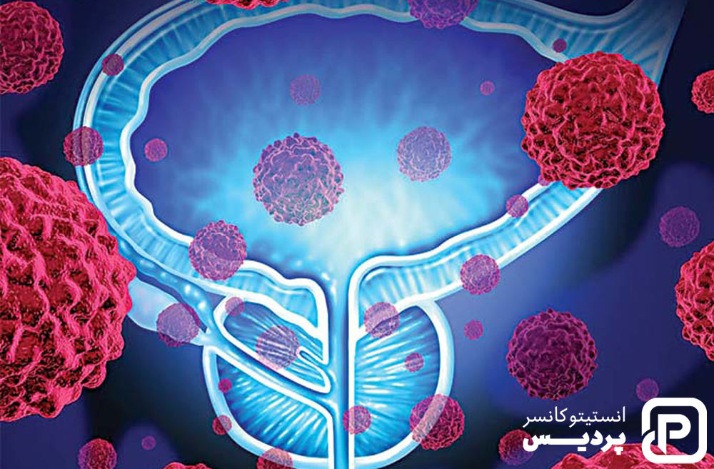 همه چیز در مورد سرطان مثانه 6 عوامل خطر سرطان مثانه