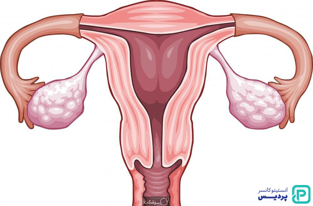 روش های درمانی سرطان تخمدان را بشناسید 4 روش های درمانی سرطان تخمدان