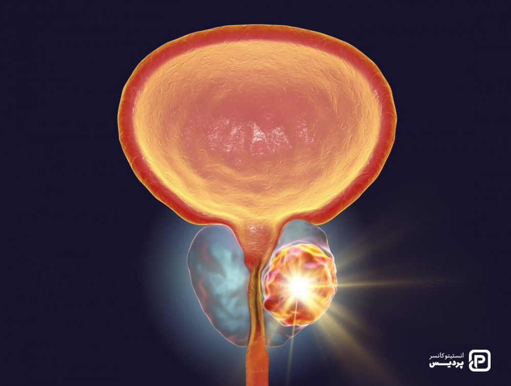انواع سرطان پروستات