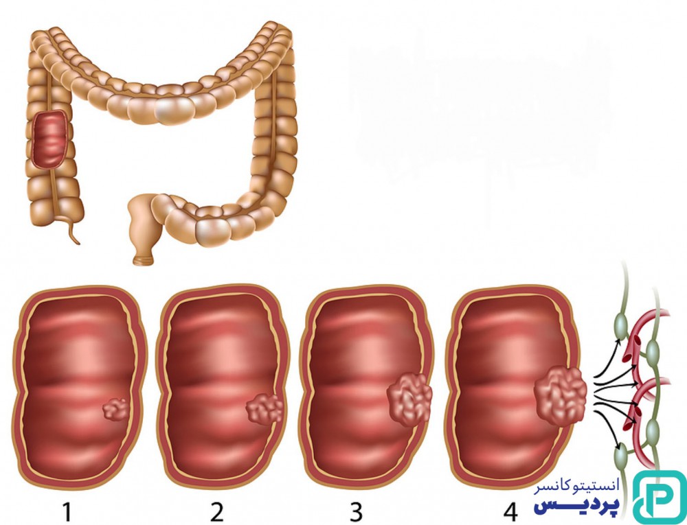 پیشرفت سرطان روده چگونه اندازه گیری می شود؟