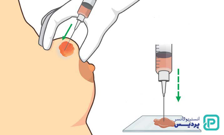 چگونه بیوپسی پستان به تشخیص سرطان سینه کمک می کند؟ 2 نمونه برداری پستان