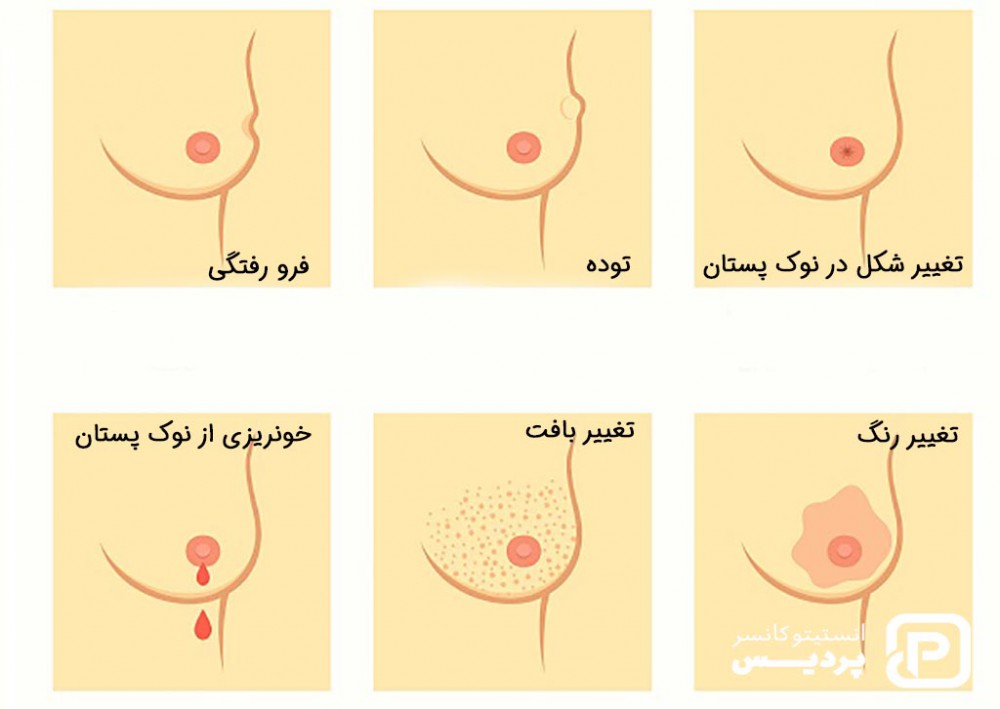 سرطان سینه و هر آنچه که درباره سرطان پستان باید بدانید 5 نشانه های سرطان سینه
