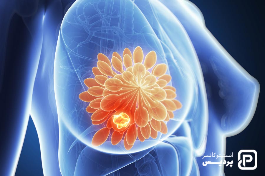 سرطان سینه و هر آنچه که درباره سرطان پستان باید بدانید 4 سرطان سینه