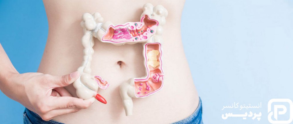 درمان سرطان روده 