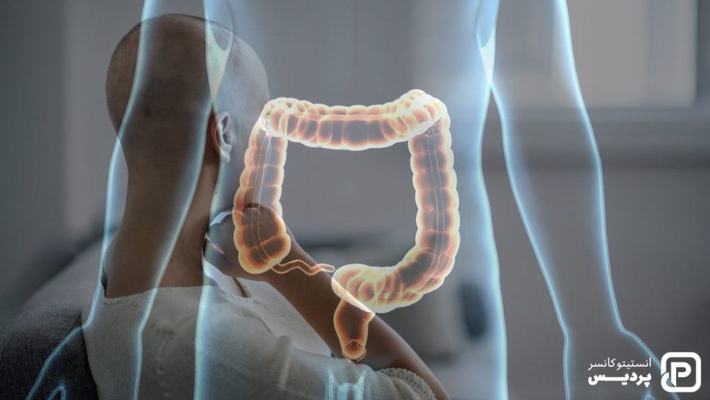 شیمی درمانی چگونه به درمان سرطان روده بزرگ کمک می کند؟ 4 یکی زا عوارض شیمی درمانی در درمان سرطان روده، ریزش موها می باشد