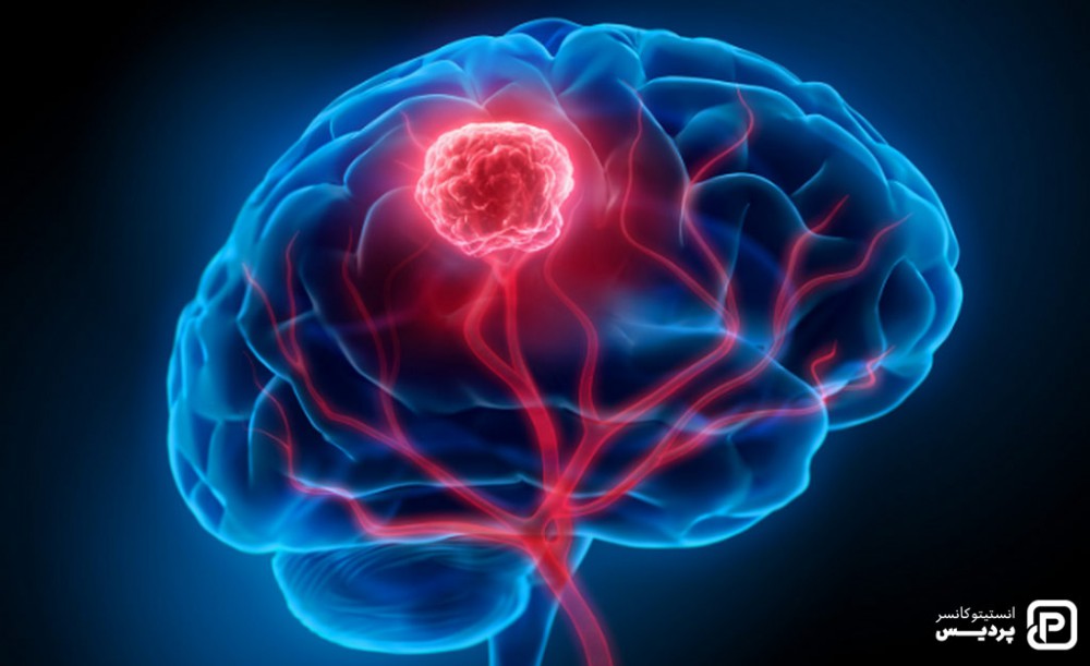 تومور مغز و نخاع از انواع سرطان در کودکان می باشد