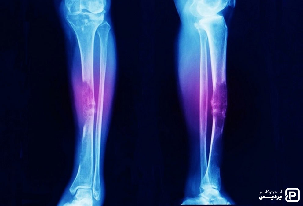 سرطان استخوان یکی از انواع سرطان در کودکان می باشد