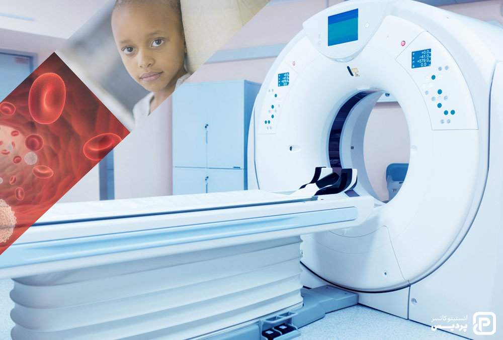 پرتودرمانی برای درمان سرطان خون در کودکان