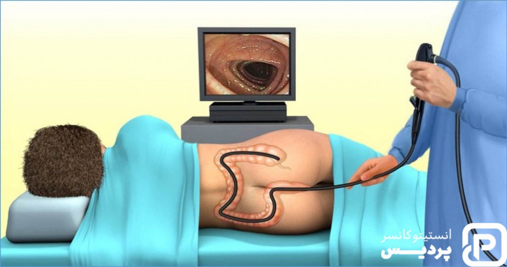تشخیص سرطان روده 